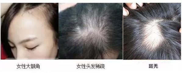 头发稀缺少什么原因引起的