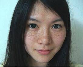 女人张斑是什么原因引起的