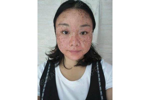 脸上死皮多用什么产品