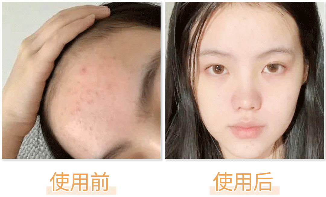 越洗黑头越多是为什么