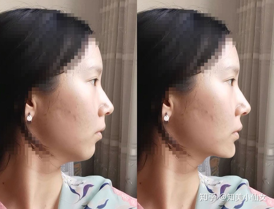 脸上侧边痘痘什么原因 脸上长痘痘用什么