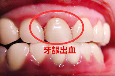 下牙牙龈一按就出血吃什么东西