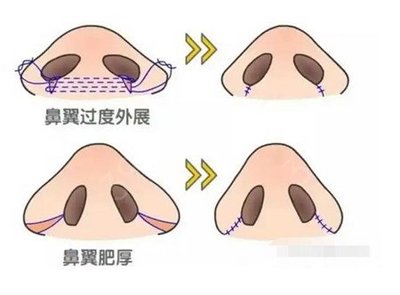 打什么针可缩鼻翼