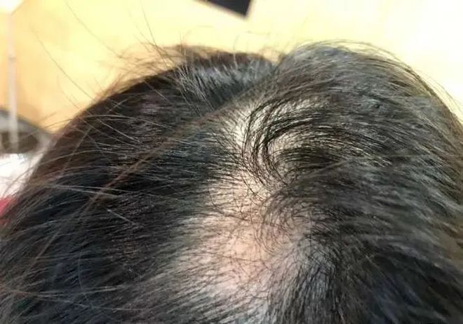 掉头发去什么医院好