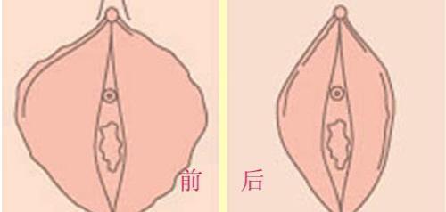 私密紧致手术什么意思