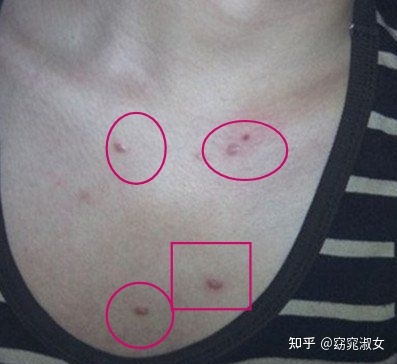 胸前突然长痘痘是什么原因
