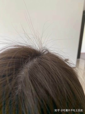 女生掉头发因为什么原因