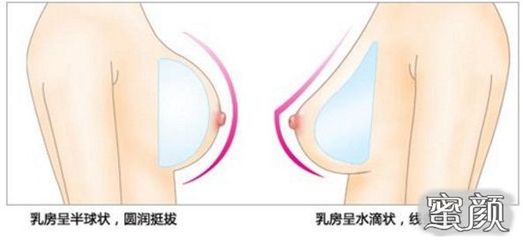 隆胸假体什么形状好