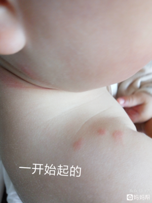 为什么夏天皮肤容易过敏 一到夏天就容易过敏怎么办