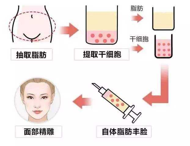 什么人不 适合做脂肪填充