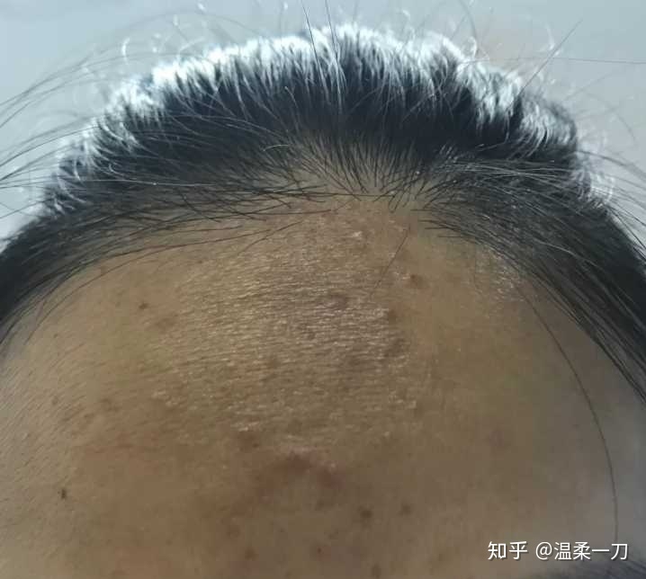 为什么脸一直反复长痘 脸两侧一直长痘是为什么