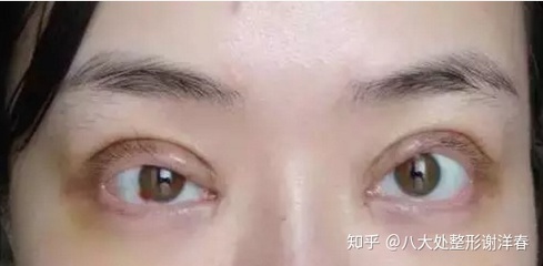 双眼皮为什么变松弛
