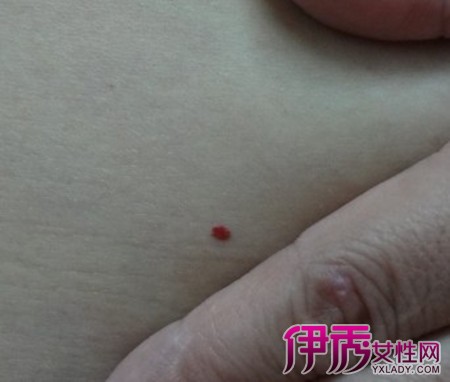 毛细血管扩张症是什么