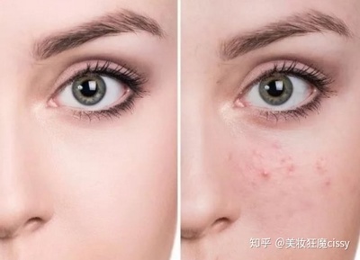 痘痘皮肤用什么粉底液好