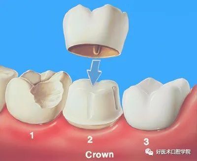 烤瓷牙为什么要带临时冠
