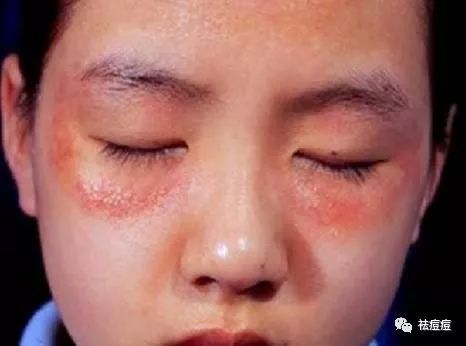 脸上起皮还干疼,怎么办? 脸部起干皮刺痛怎么办