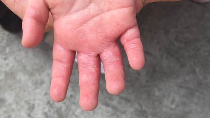 宝宝烫伤后疤痕增生有什么特点