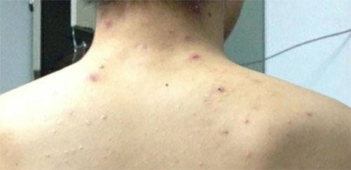 背脊上长痘是什么原因