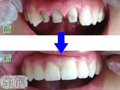 全瓷牙崩瓷是什么意思