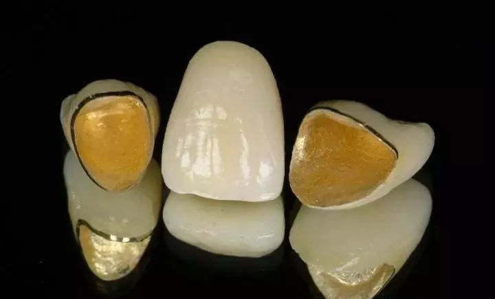 全瓷牙崩瓷是什么意思