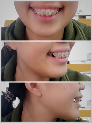 门牙做什么牙套比较好