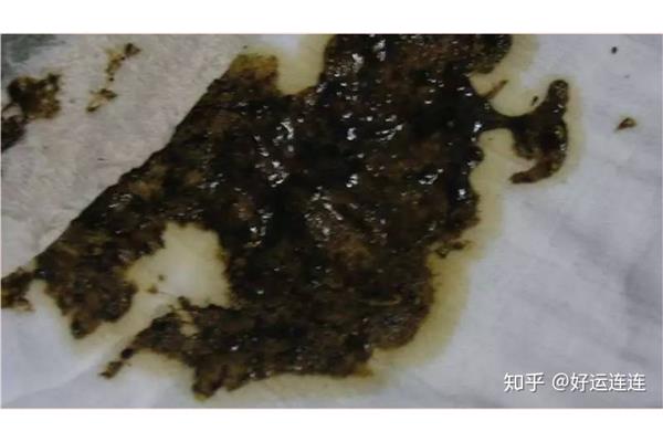 痔疮大便出血吃什么药好 吃什么可以缓解便血